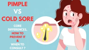 Cold Sore or Pimple on Lip? | Here are Some Ways to Know it Fast