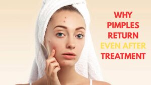 Pimples Keep Coming Back Even After the Treatment ? | Full Guide